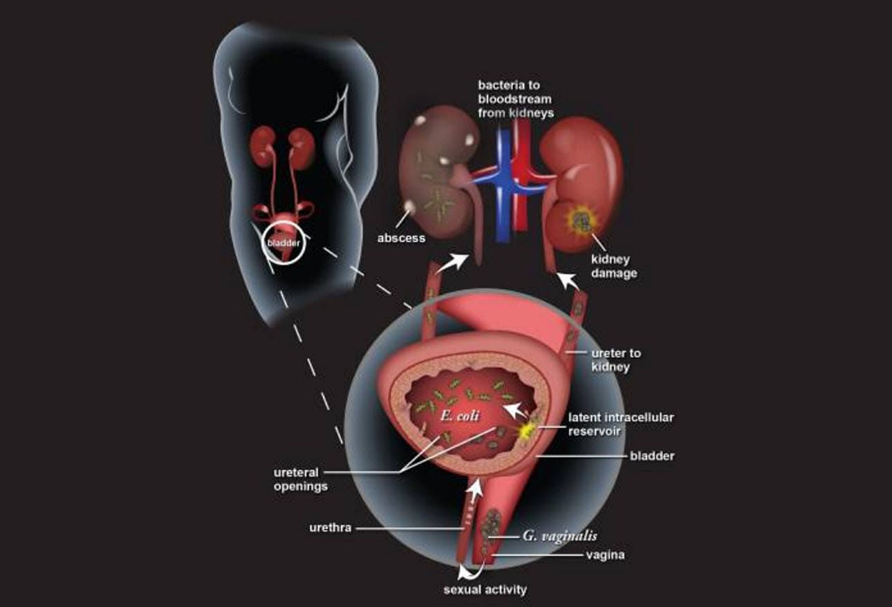 Wallpaper #2D780 182 Bacterial Infections of the Urinary System Biology Libretexts