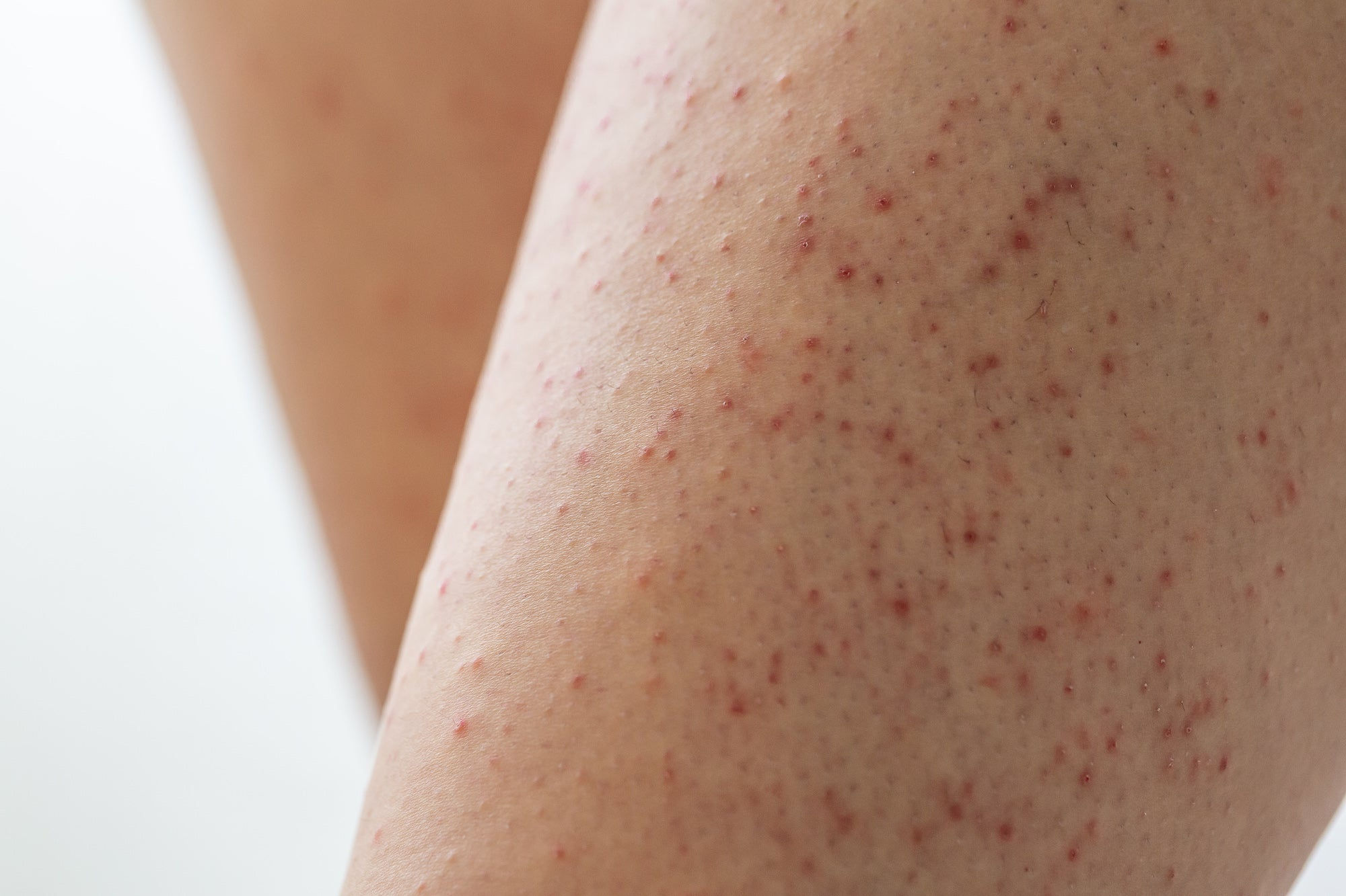 Wallpaper #w2gaH5MBSpphPi3-1yqM231 Itchy Bumps on Arms