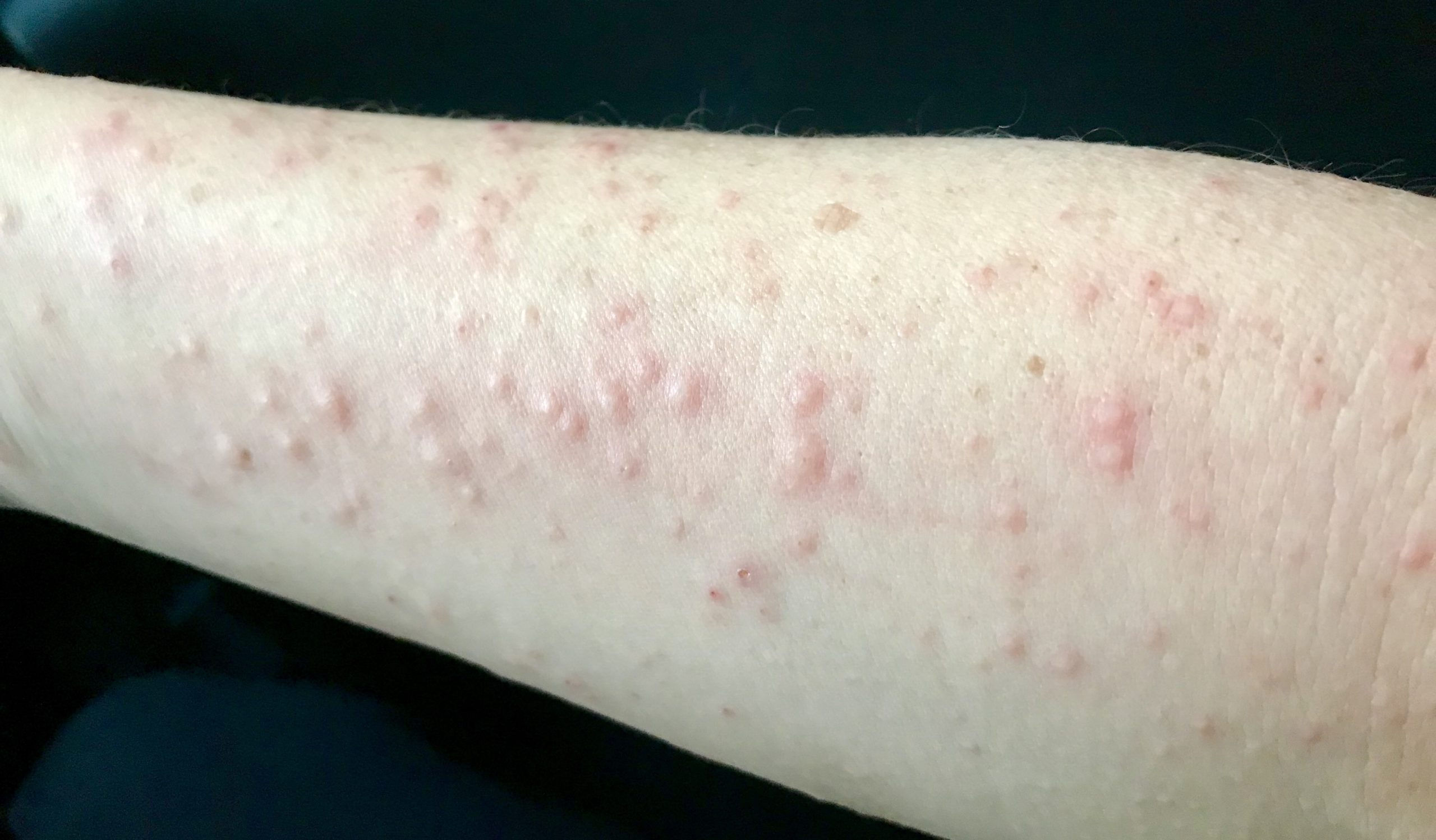 Wallpaper #w2gaH5MBSpphPi3-1yqM261 Skin Rash Itchy Red Bumps