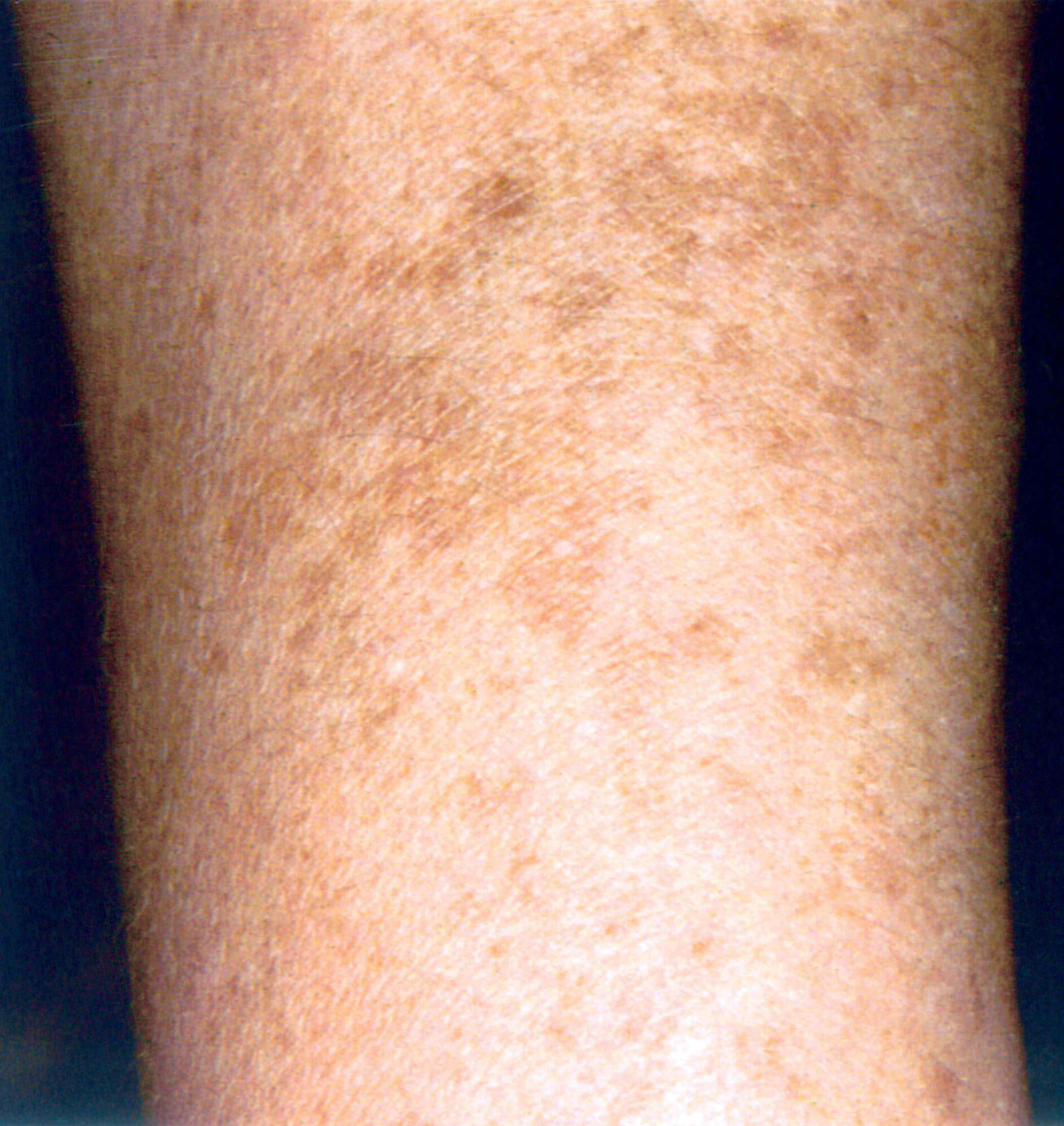 Wallpaper #w2gaH5MBSpphPi3-1yqM235 Dark Spots on Arms Treatment at Alexander Hickman Blog