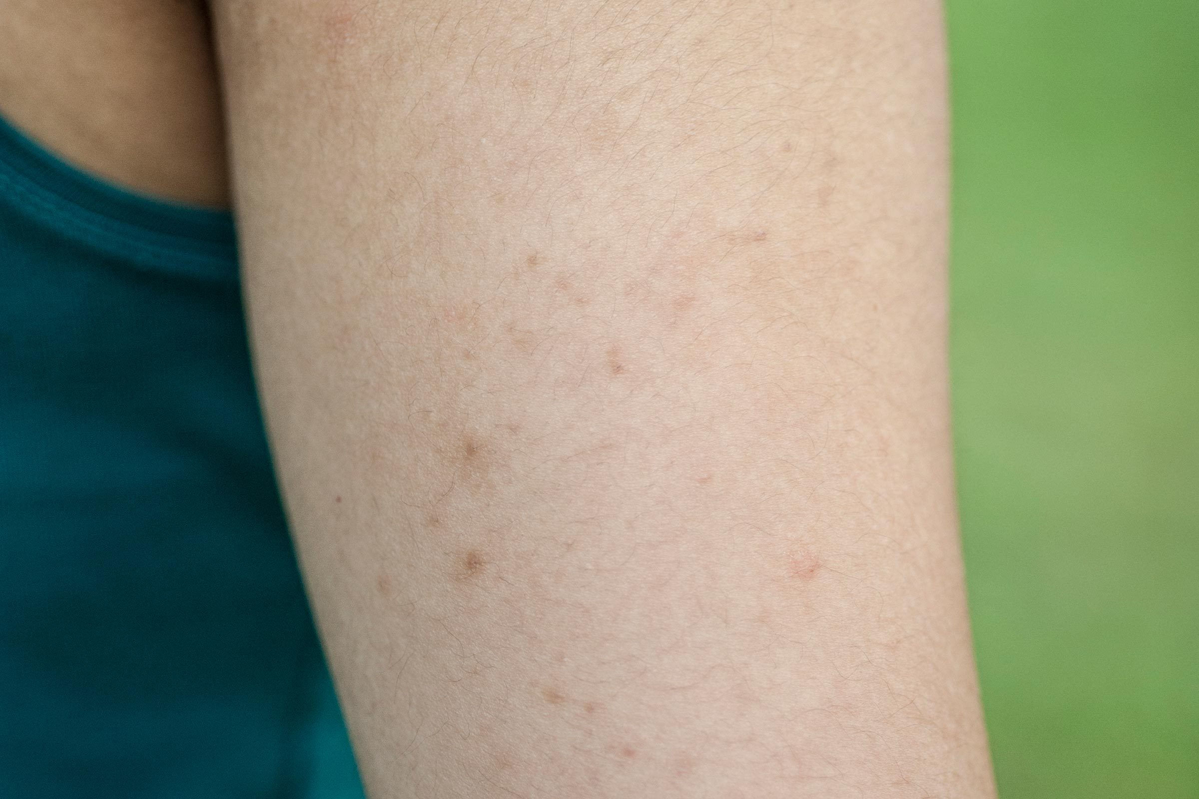Wallpaper #w2gaH5MBSpphPi3-1yqM259 Keratosis Pilaris How to Get Rid of Chicken Skin Best Health Canada