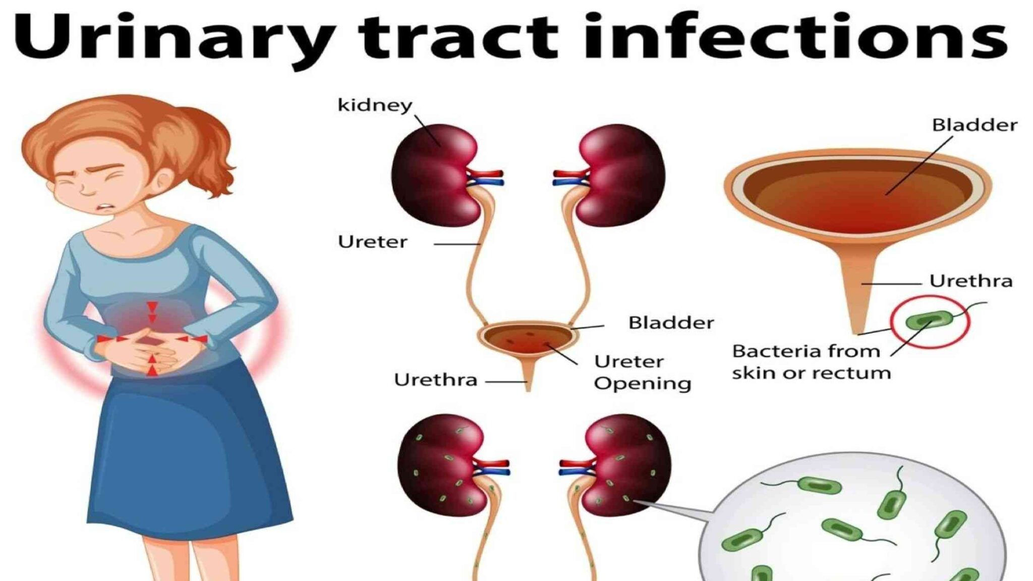 Wallpaper #2D780 182 Bacterial Infections of the Urinary System Biology Libretexts