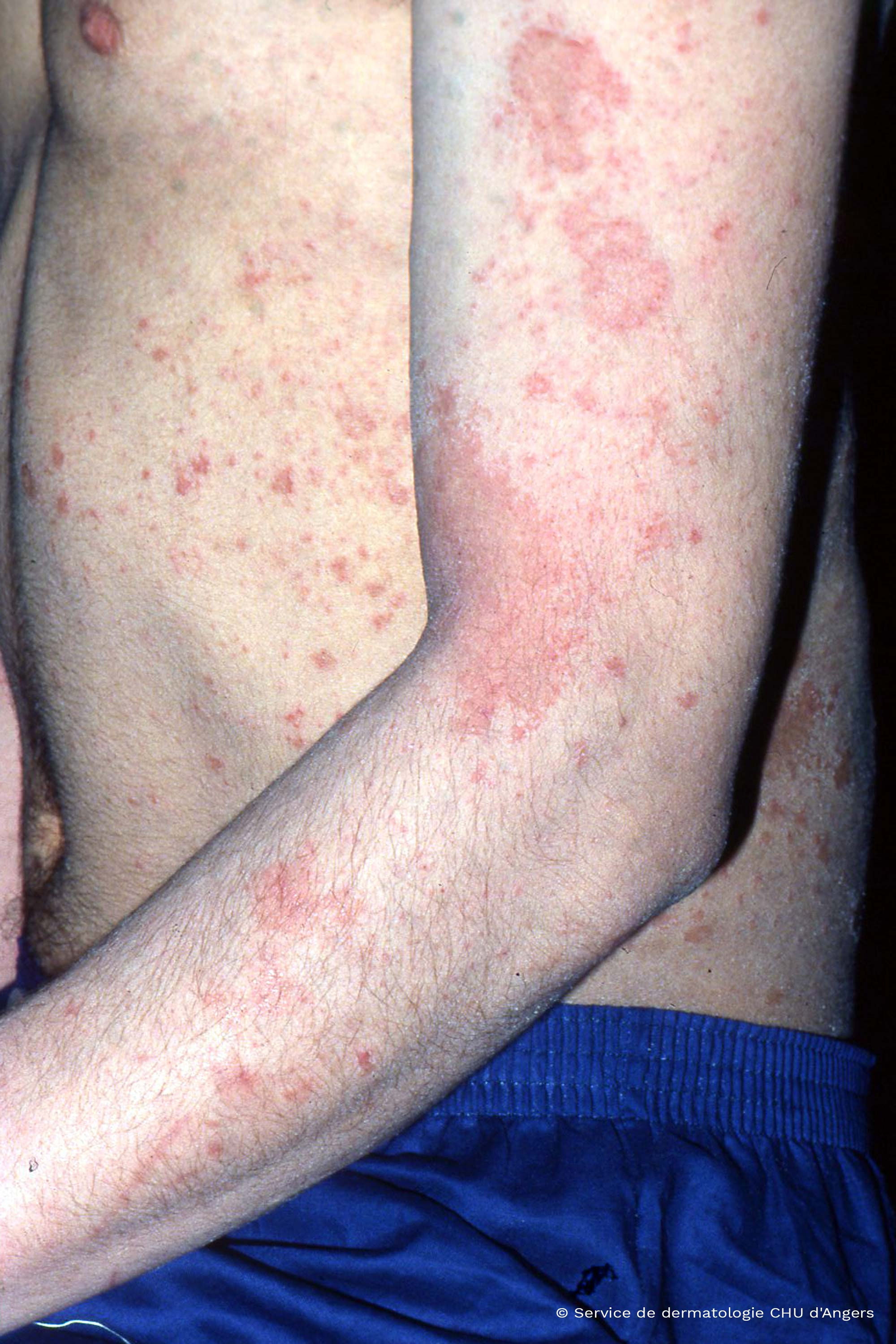 Wallpaper #w2gaH5MBSpphPi3-1yqM269 Eczema Bumps on Arms