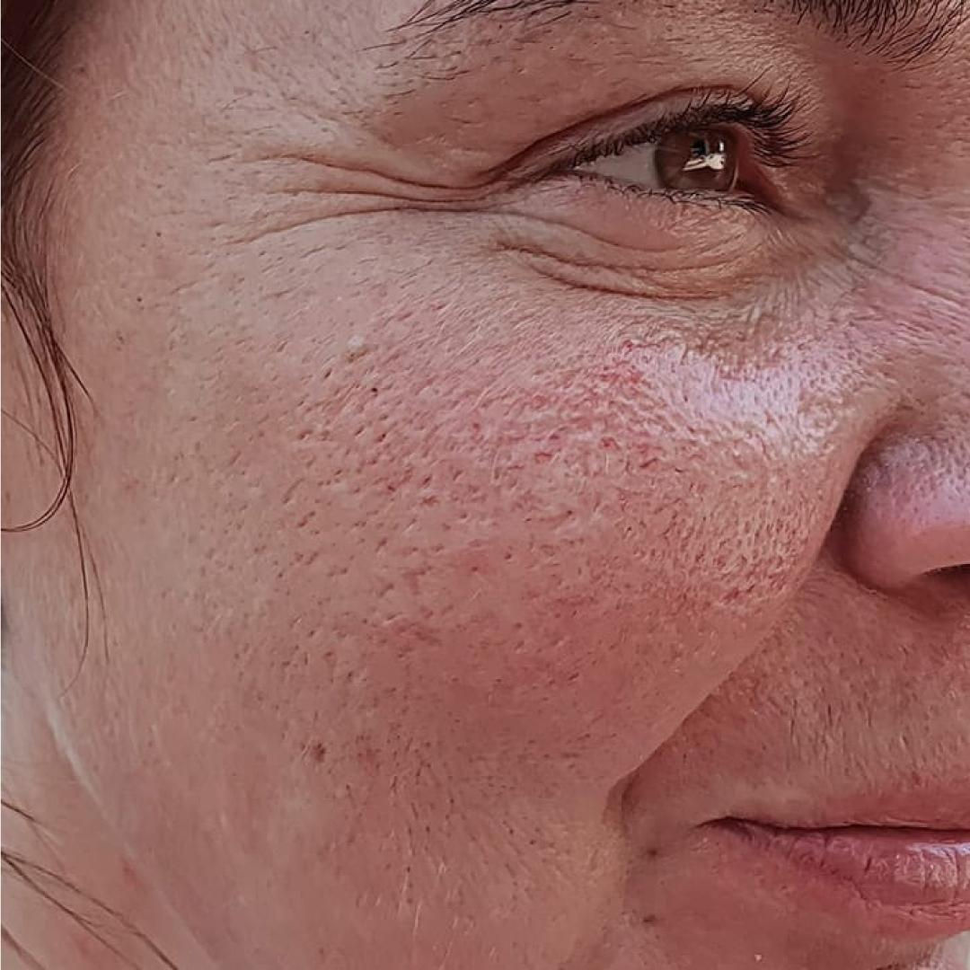 Wallpaper #6FMrNZMBYjRkjcHs2Ogk271 How to Get Rid of Textured Skin from the Face