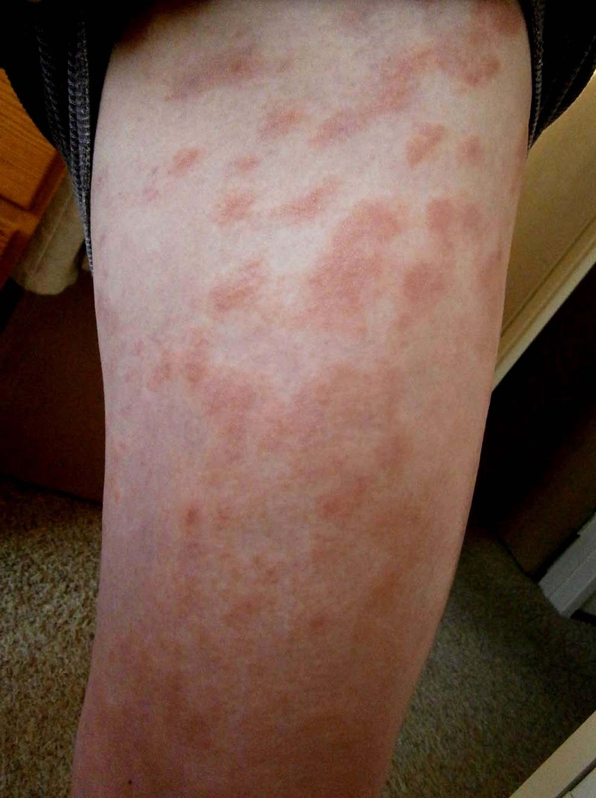 Wallpaper #w2gaH5MBSpphPi3-1yqM222 How to Remove Small Bumps on Arms at Martin Lockwood Blog
