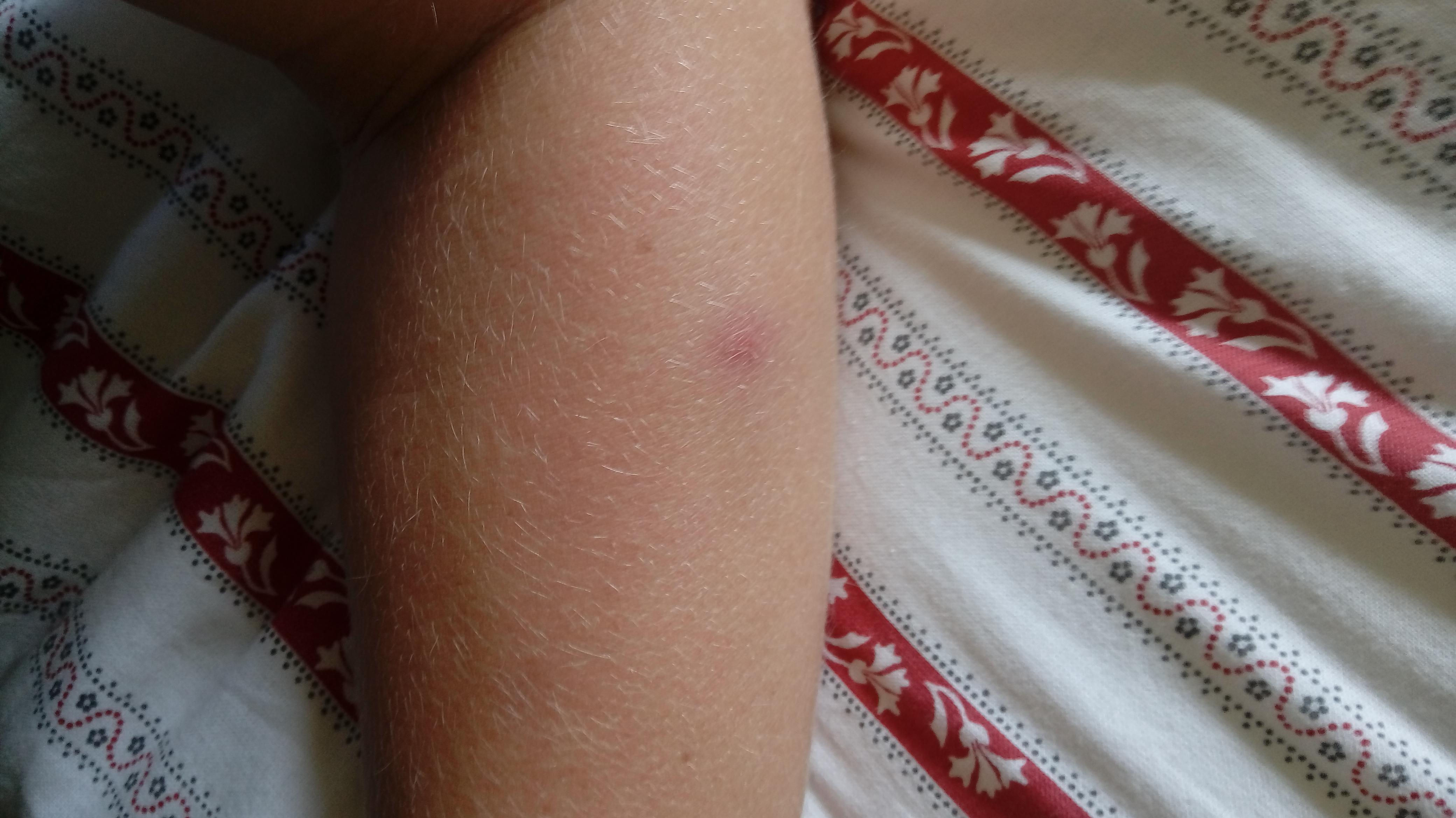 Wallpaper #w2gaH5MBSpphPi3-1yqM173 Weird Red Dot on Arm Its Been Their for 3 Days What Could It Be R