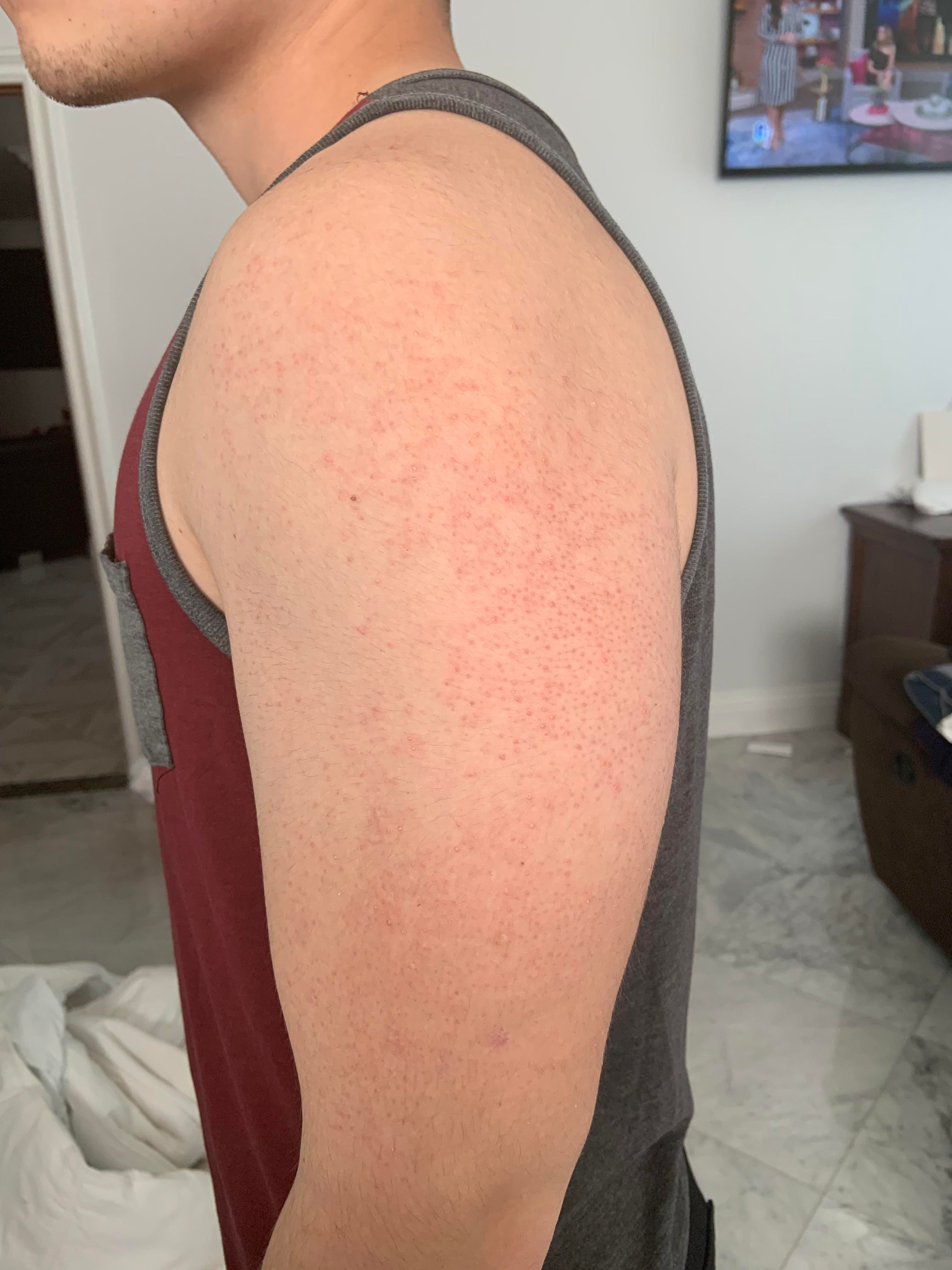 Wallpaper #w2gaH5MBSpphPi3-1yqM223 Skin Concerns How Can I Treat These Bumps All Around Both of My Arms
