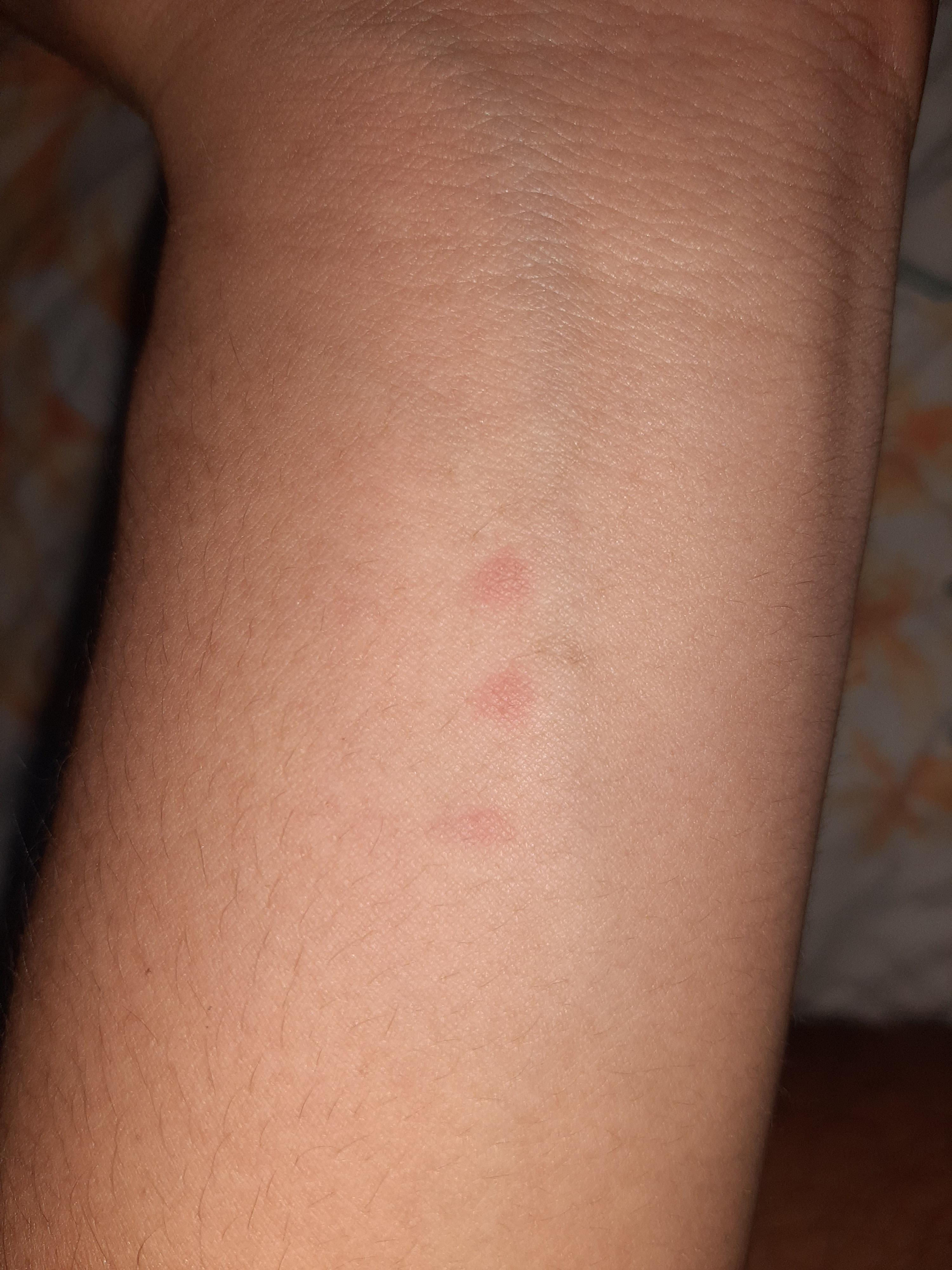 Wallpaper #w2gaH5MBSpphPi3-1yqM214 Three Red Dots Suddenly Appeared at My Wrist Rmildlyinteresting
