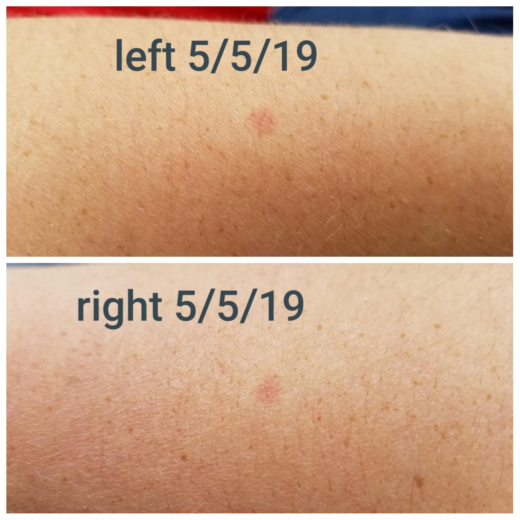 Wallpaper #w2gaH5MBSpphPi3-1yqM178 Red Dots on Arm Heat at Rebecca Barnes Blog