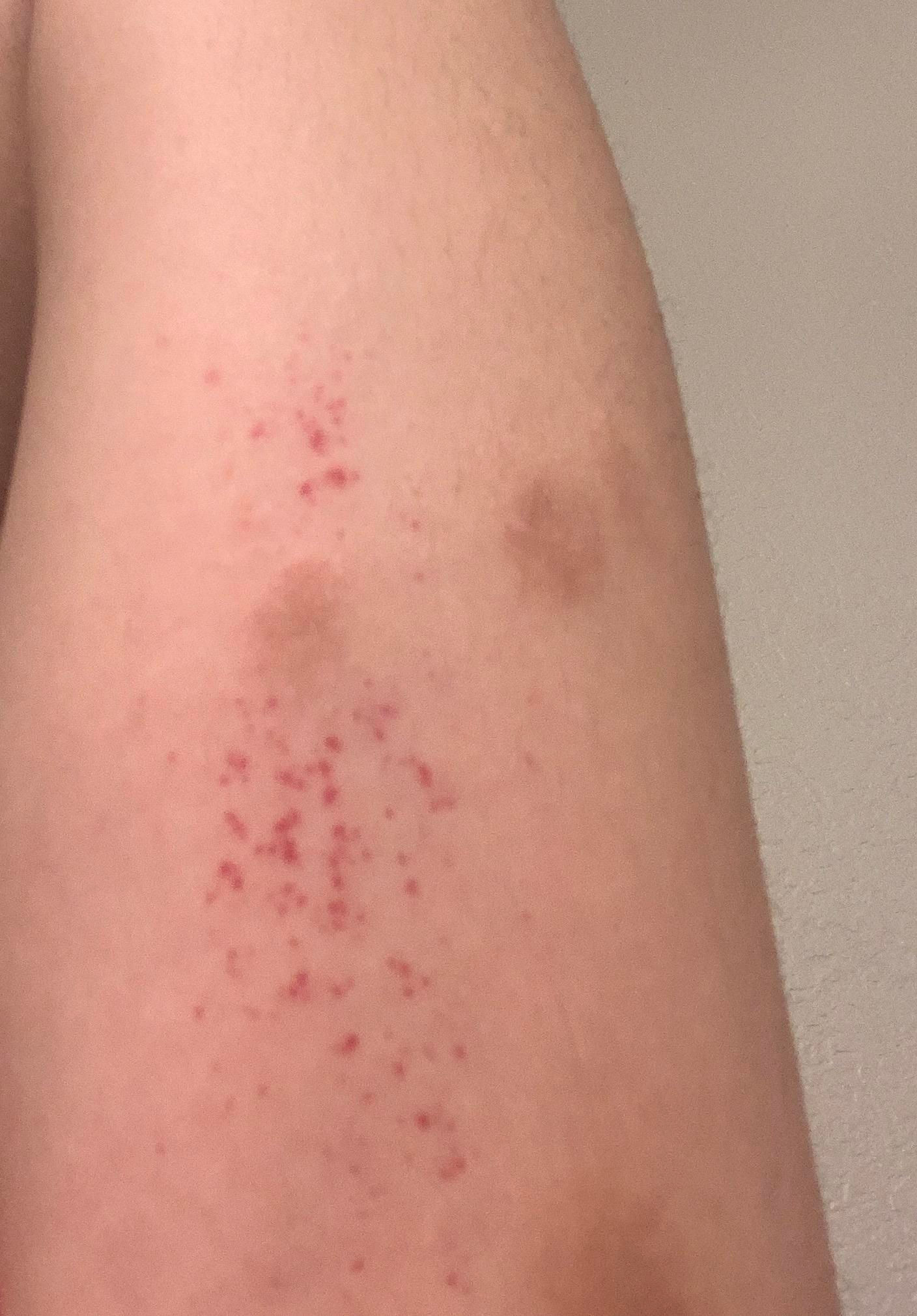 Wallpaper #w2gaH5MBSpphPi3-1yqM249 Flat Red Dots Ignore the Eczema Spots Dots Are Not Itchy or Painful