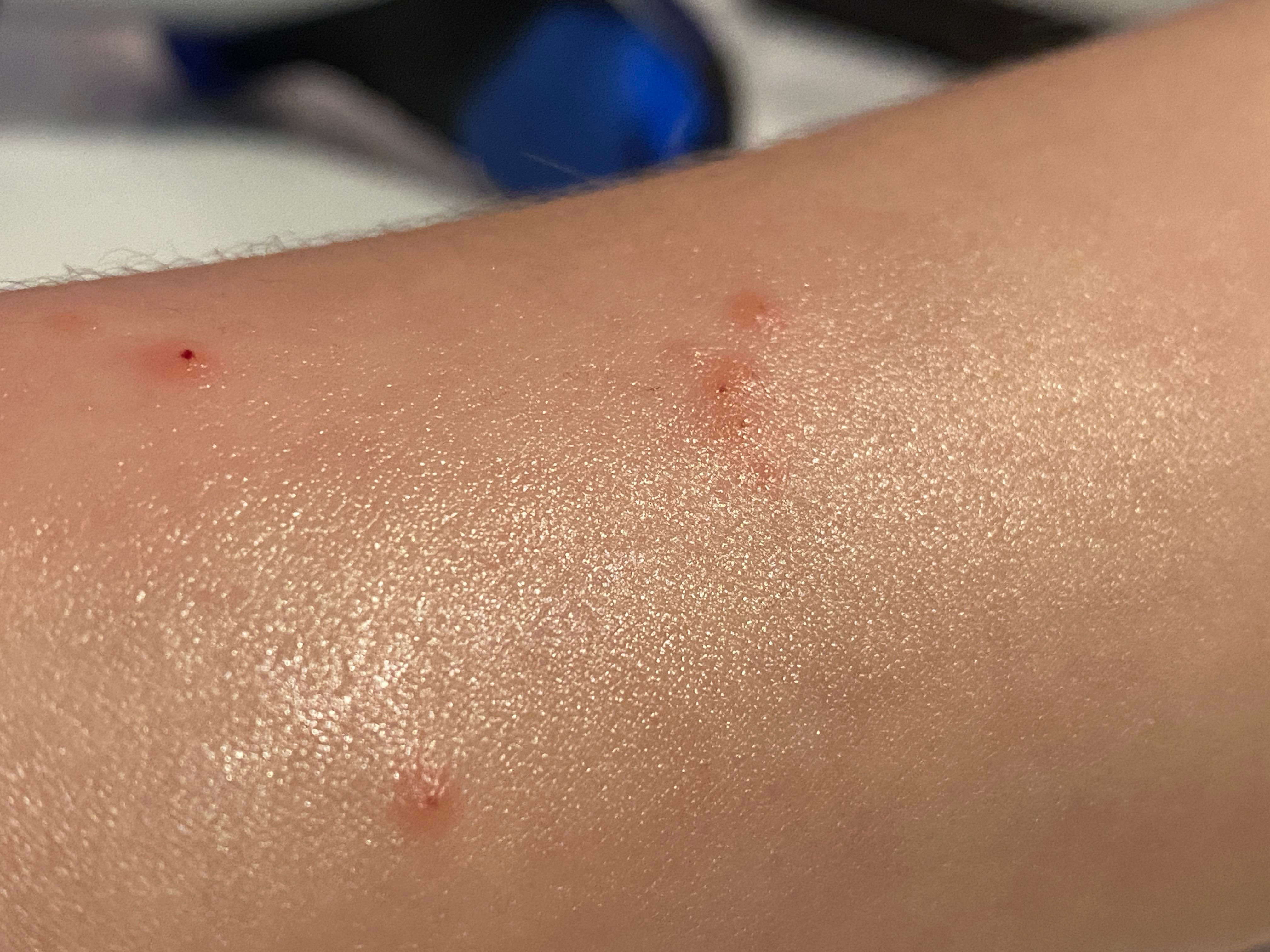Wallpaper #w2gaH5MBSpphPi3-1yqM248 Itchy Skin Bumps on Arms