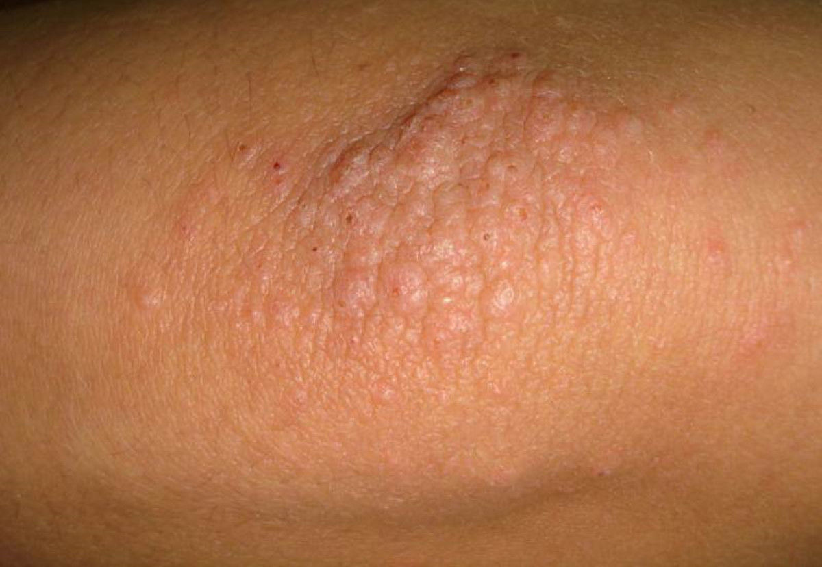 Wallpaper #w2gaH5MBSpphPi3-1yqM221 Red Bumps on Arms During Pregnancy at Connie Crabtree Blog