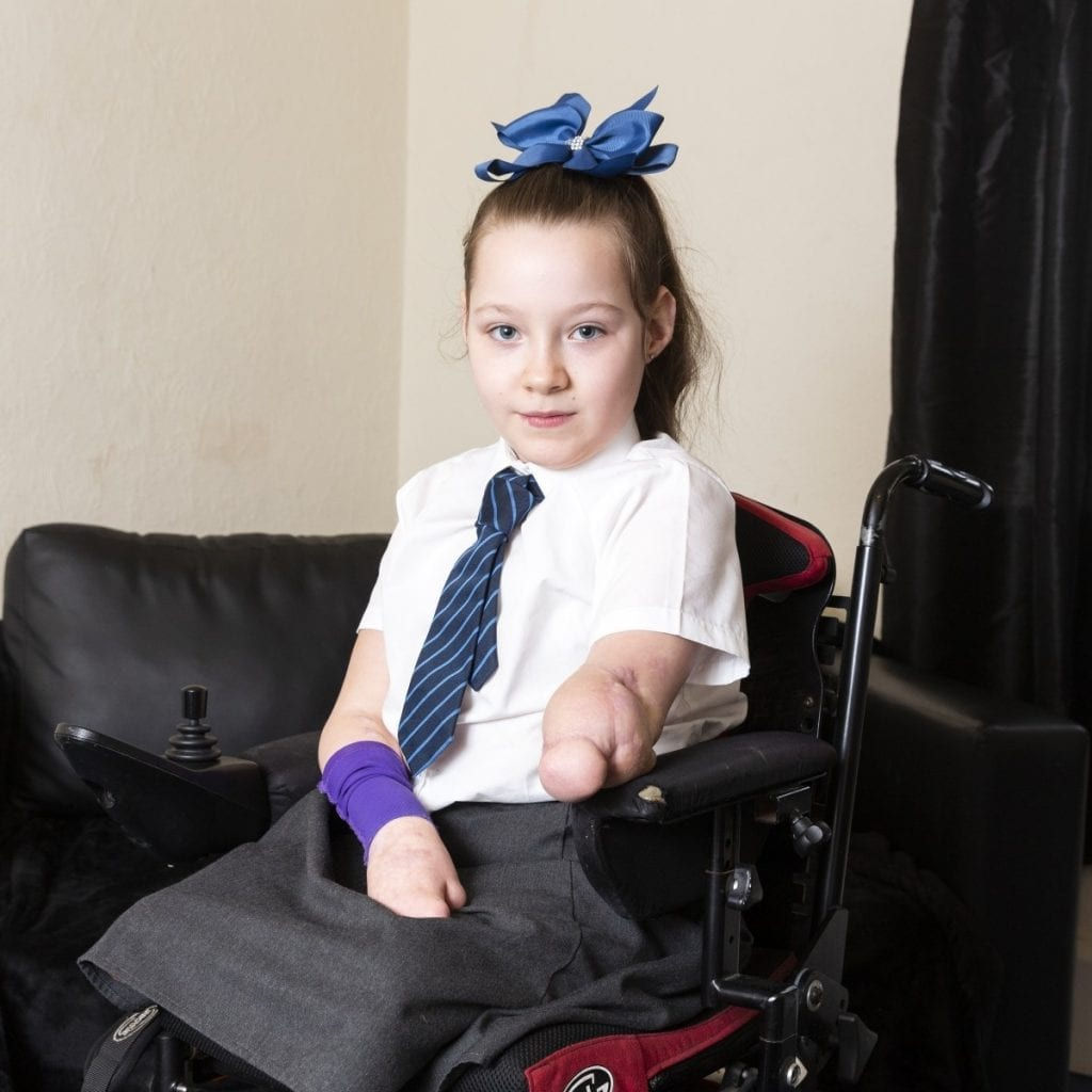 Wallpaper #AfDcf5cBi4JM6agGcSER33 Incredibly Brave Nine Year Old Amputee is Dreaming of a Bionic Hero Arm