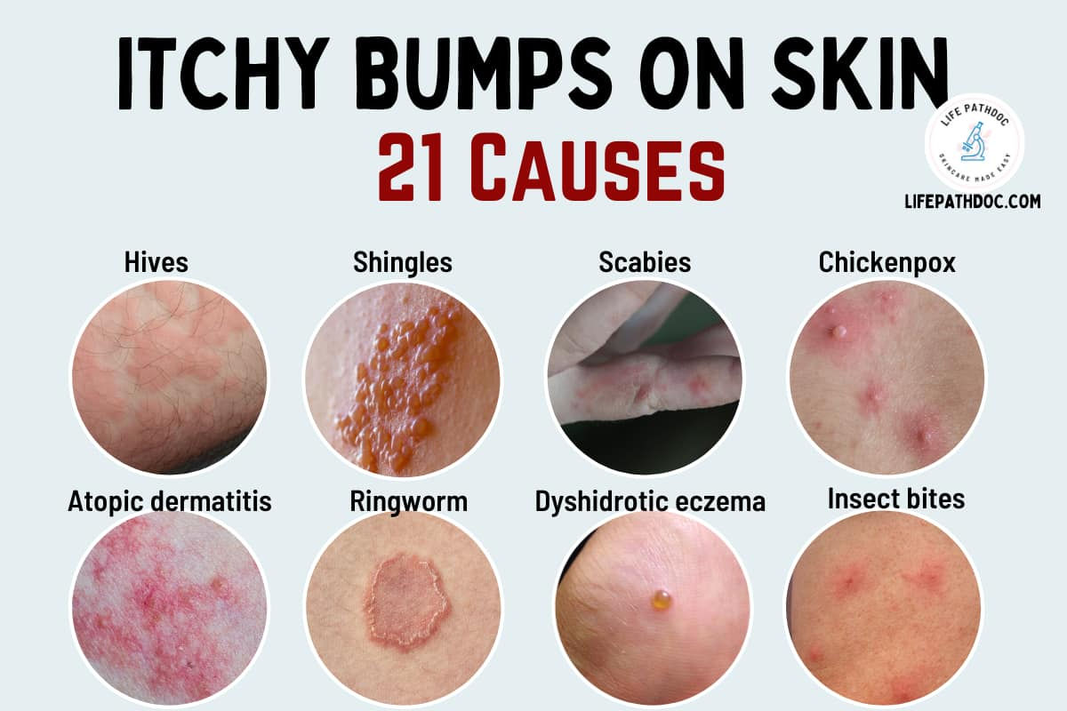 Wallpaper #w2gaH5MBSpphPi3-1yqM174 Itchy Bumps on Skin 21 Causes Pictures and Treatment