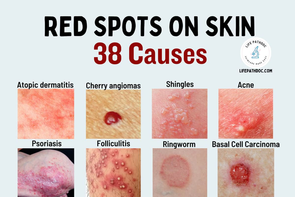 Wallpaper #w2gaH5MBSpphPi3-1yqM254 Tiny Red Dots on Skin