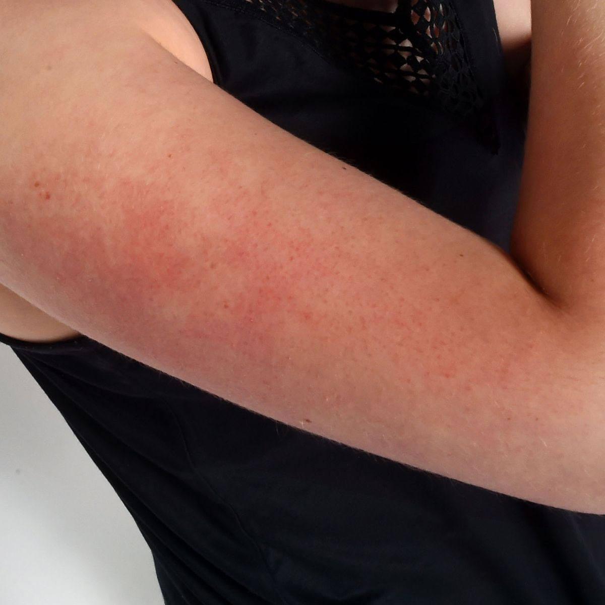 Wallpaper #w2gaH5MBSpphPi3-1yqM229 Dark Red Spots on Arm