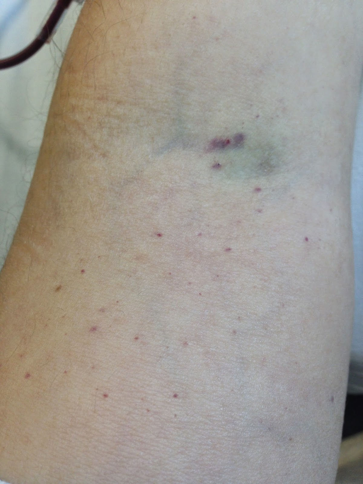 Wallpaper #w2gaH5MBSpphPi3-1yqM255 Red Spot on Arm for Weeks at Michele Toney Blog